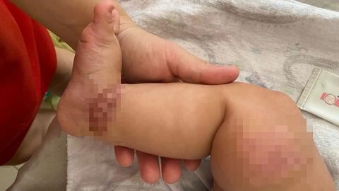 Bebê sofre necrose no pé após suposto erro em medicação intravenosa