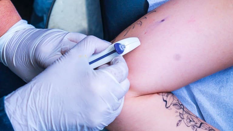 Paraíba vai ofertar contraceptivo subdérmico em João Pessoa e em outras 10 cidades